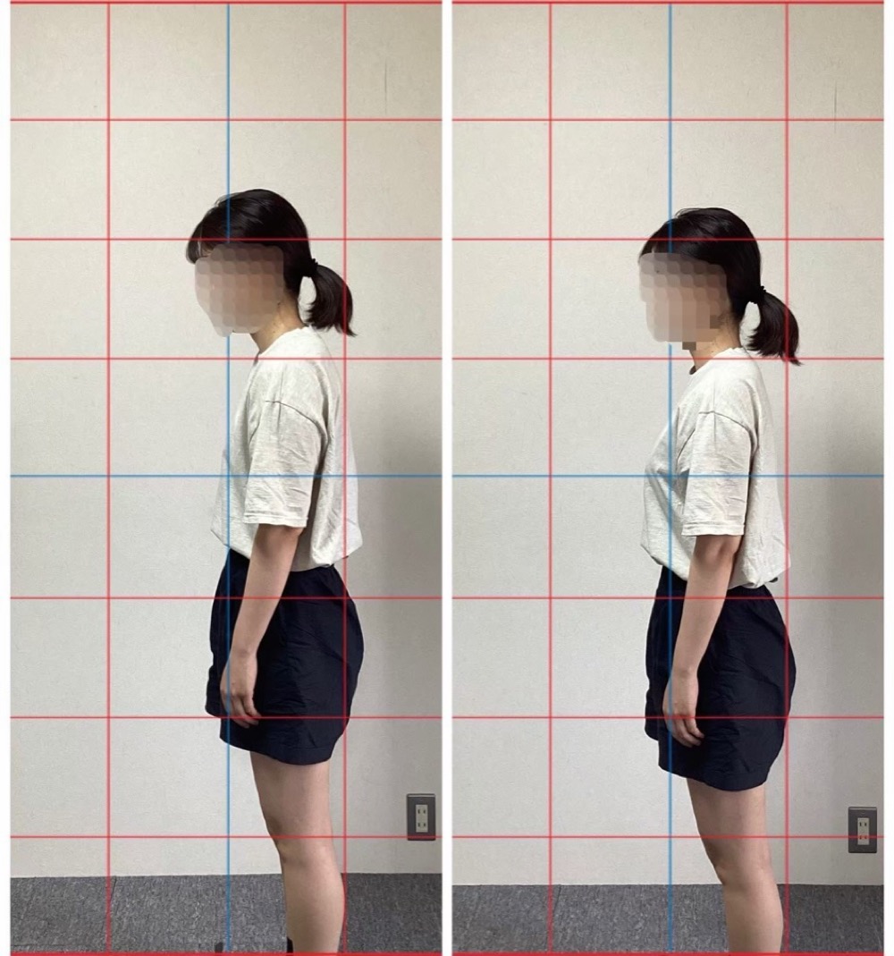 姿勢のビフォーアフター：頭が前に出る姿勢から、耳と肩のラインが整った姿勢へ