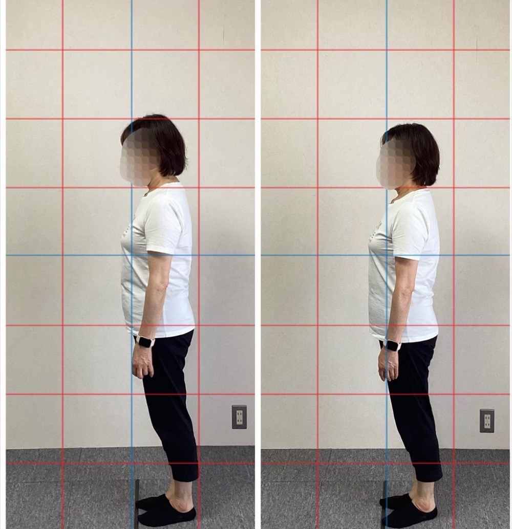 姿勢のビフォーアフター:首の前傾と背中の丸まりが整い、胸が開いた姿勢へ